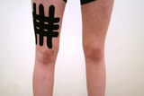 kinesiotaping: hematoom