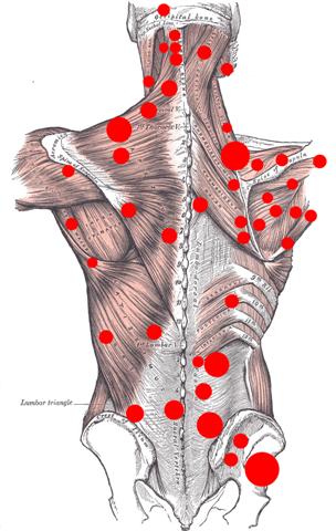 myofasciale triggerpoints